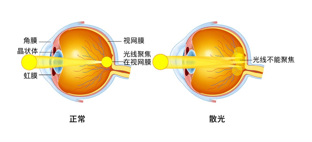 成年后散光增加的原因,眼睛散光增加怎么回事