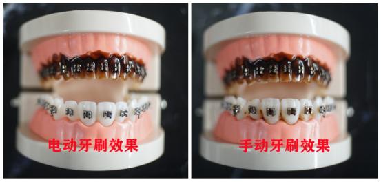 戴牙套期间需要哪些工具清洁牙齿,戴牙套用电动牙刷伤牙吗