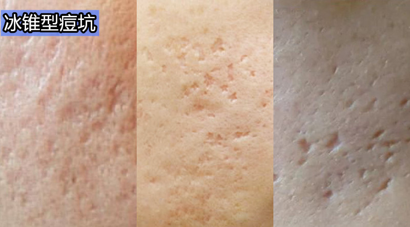 孩子起痘自卑不自信该怎么引导,孩子长青春痘不自信怎么引导