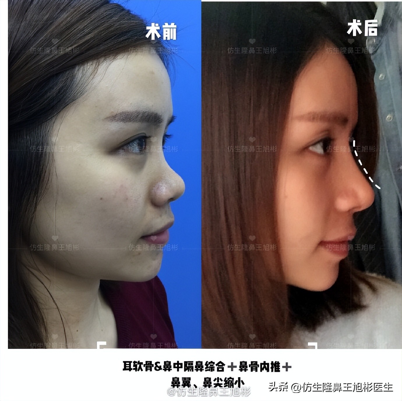 肋软骨的缺点与好处,科普什么是肋软骨鼻综合