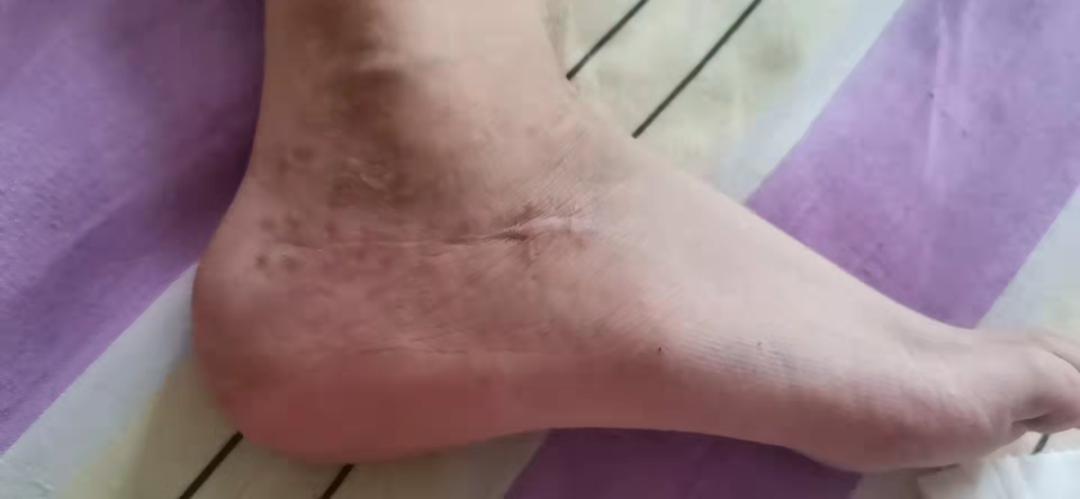 跗骨窦手术能治好吗,跗骨窦入路治疗跟骨骨折适应症