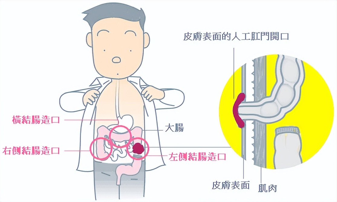 造口人术后怎么护理,造口护理的健康宣教