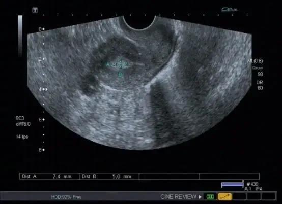 b超怎么显示子宫内膜息肉,b超发现子宫内膜息肉是癌症吗