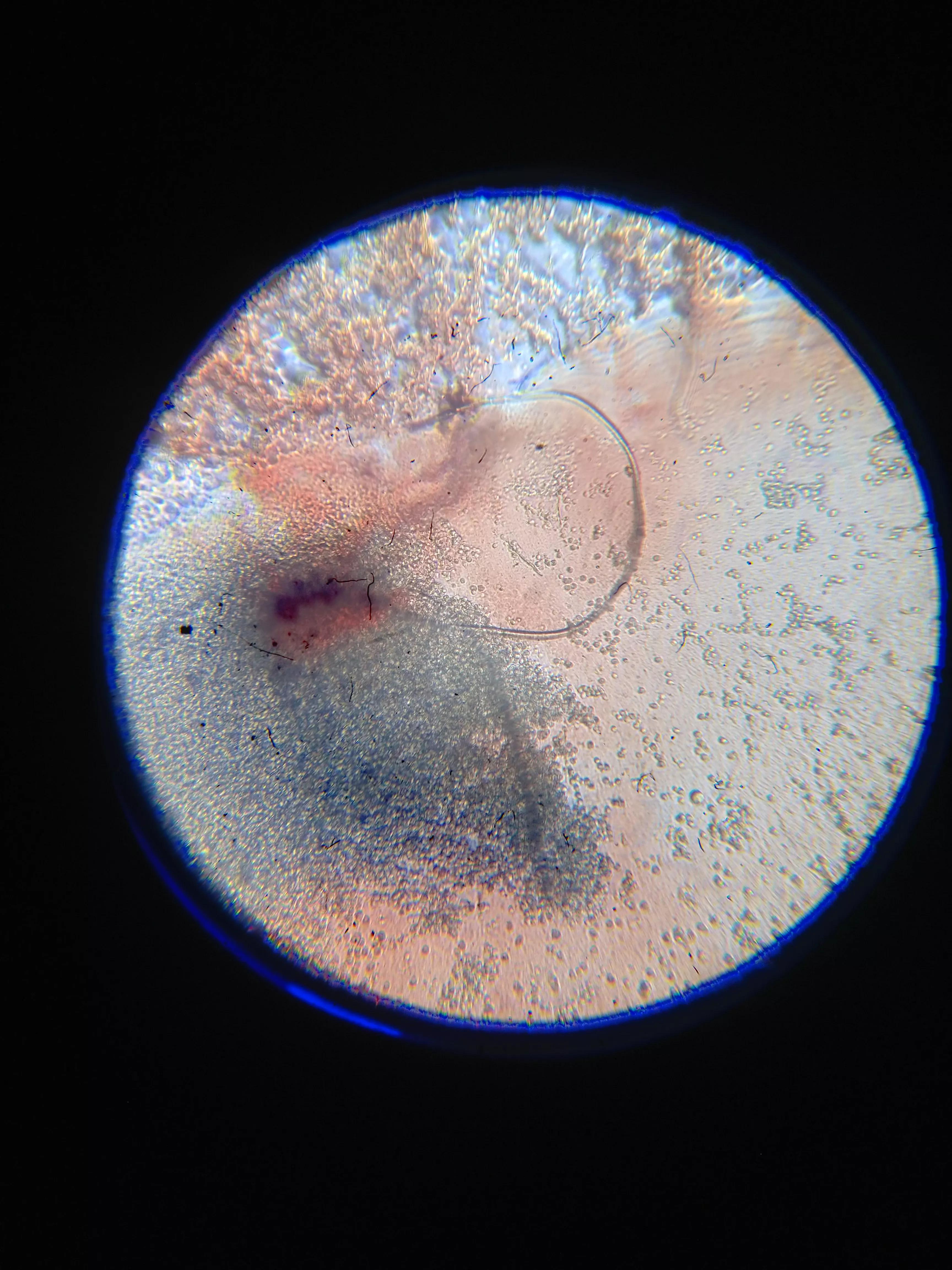 牛皮癣伴随一生是怎么样的体验,对抗牛皮癣一直在坚持