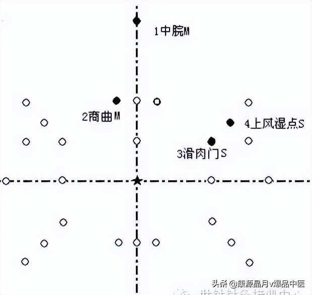 腹针疗法及16例常用处方