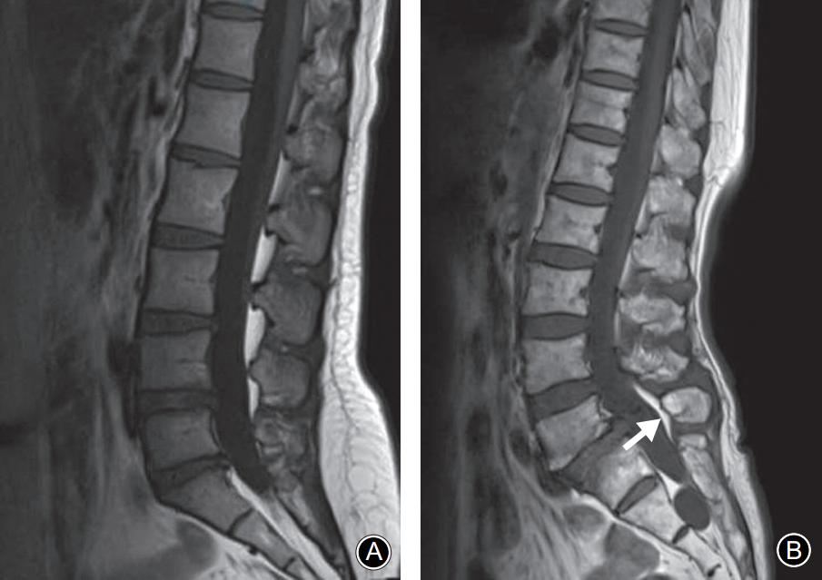 轻度峡部裂和重度峡部裂的区别,真性峡部裂和假性峡部裂