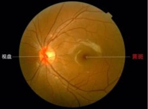 小孩眼睛长黄斑怎么回事,眼睛两边长了对称黄斑