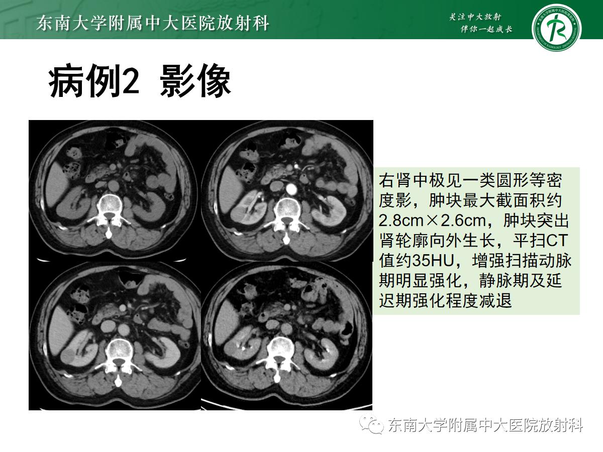 周利群谈肾嫌色细胞癌ct特点,好文分享值得深思