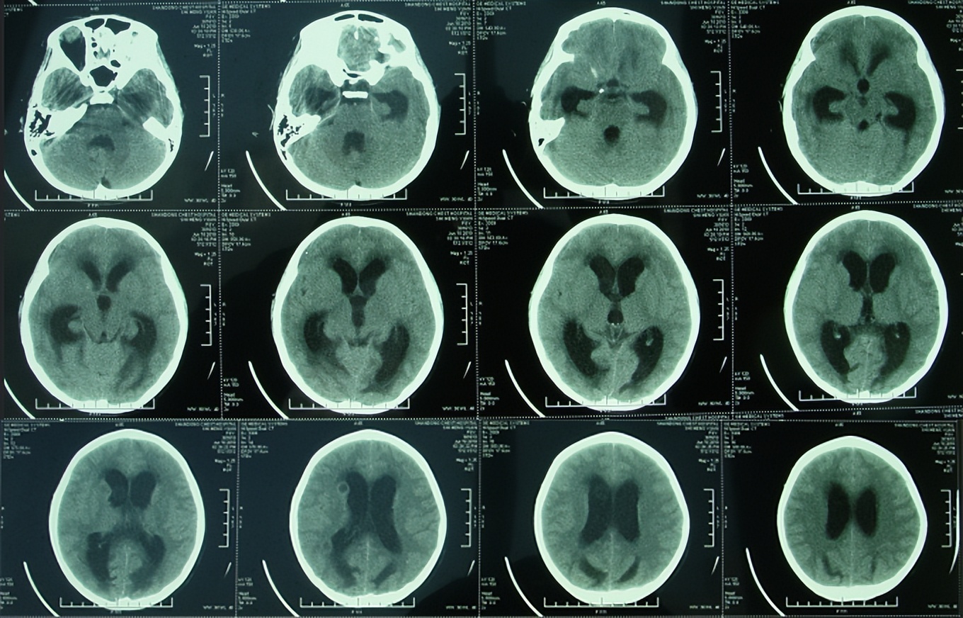 儿童结核脑膜炎脑积水,结核性脑膜炎脑积水如何引起