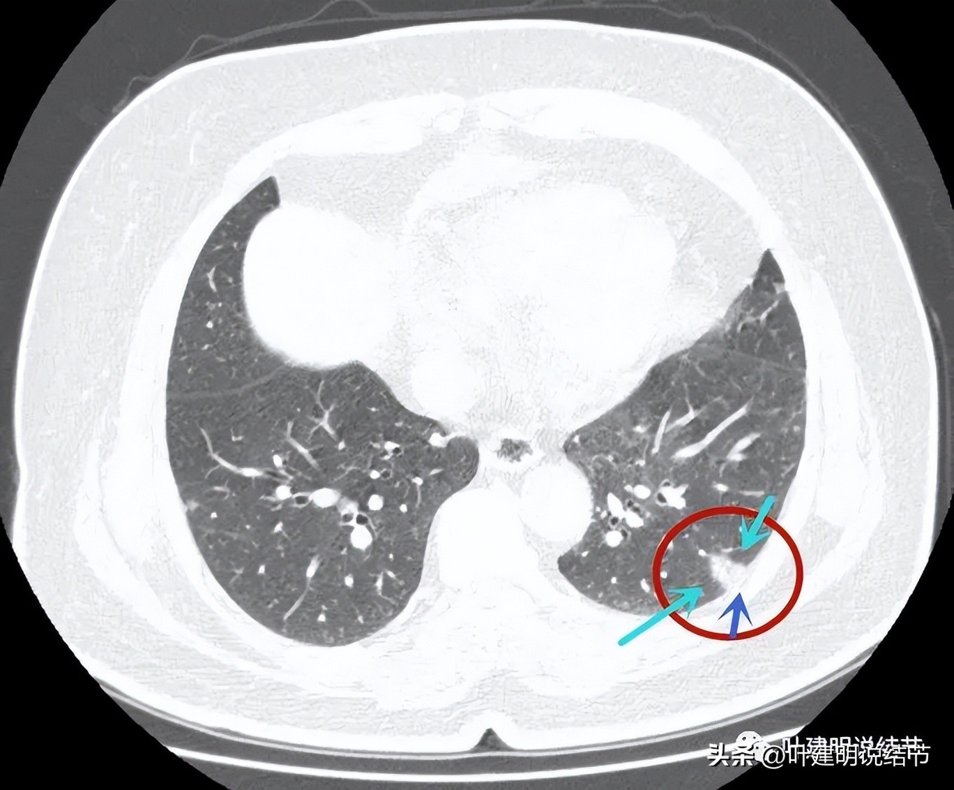 肺结节实性为什么建议抗炎治疗,肺上实性结节抗炎后变成空洞