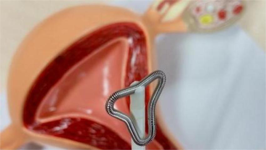 节育环在女性体内会发生哪些变化,女性节育环多少年必须取出来