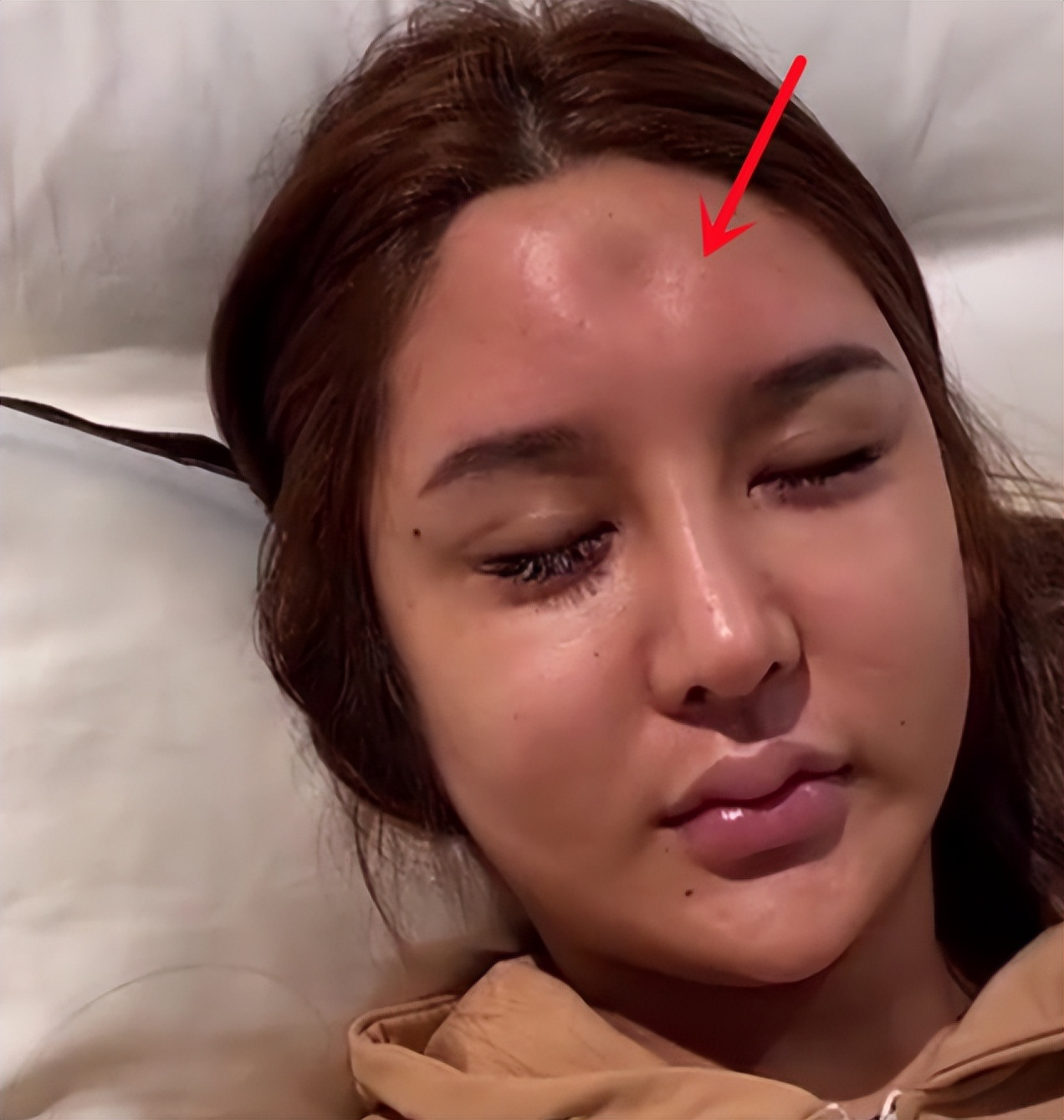 “桃花宝宝”迷恋整容，八年花费上百万，嘴歪眼斜额头出现大坑