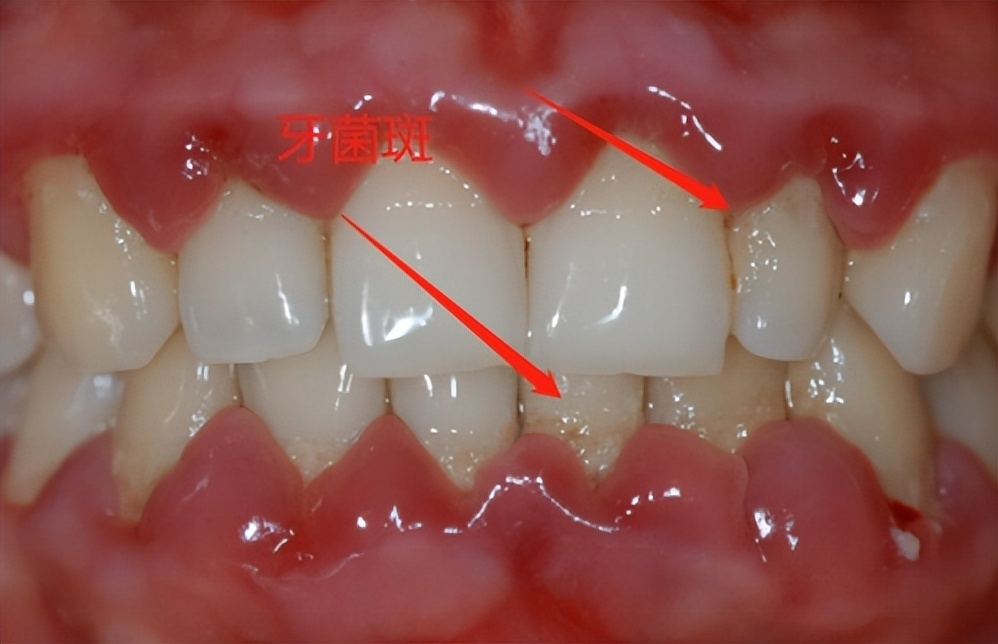 牙周炎治愈指南，这些口腔护理注意事项要牢记
