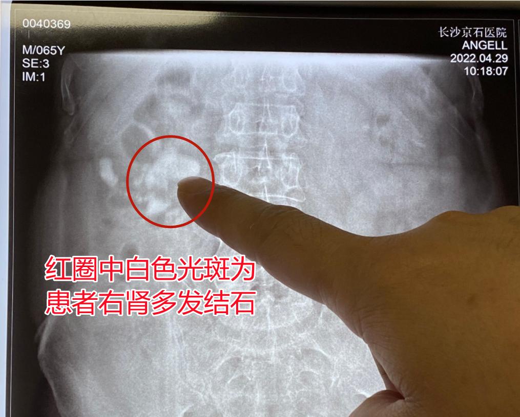 六旬嗲嗲每天一壶茶叶水，未料结石疯长险毁肾