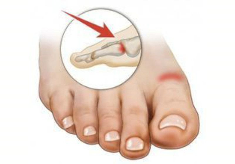 大脚趾长歪了指甲也歪,大脚趾拇囊炎是怎么引起的