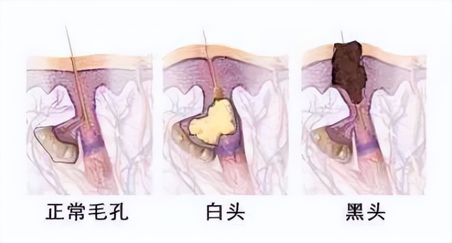 毛孔粗大如何改善治愈系,解决毛孔粗大最有效的方法医美