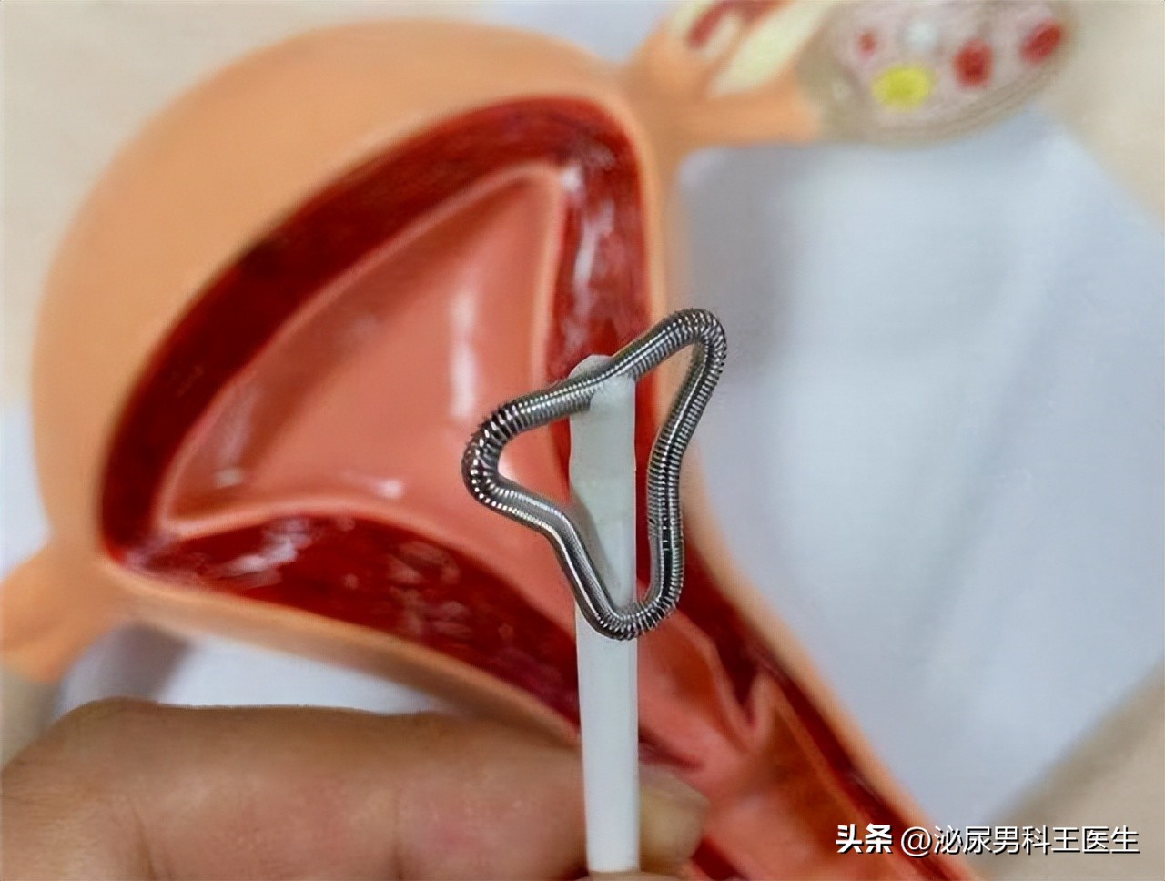 节育环多大年龄取出好取,节育环一直不摘