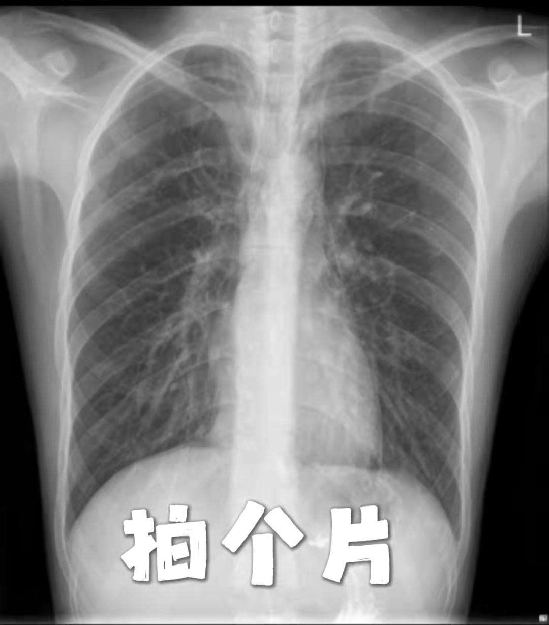 关注|纵隔，你“肿”么了？