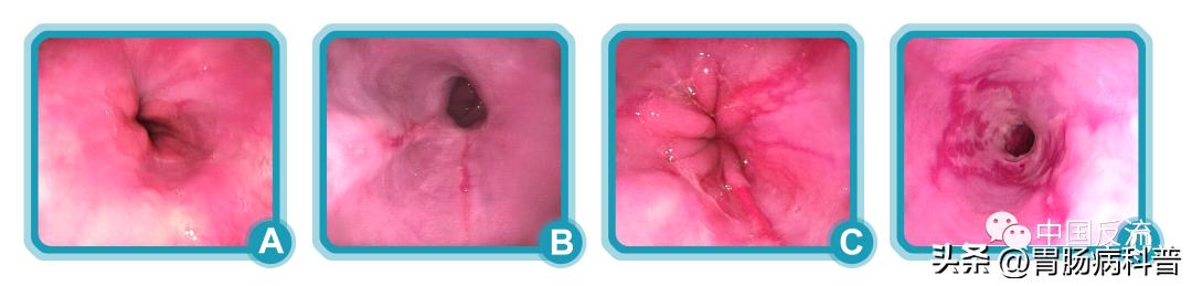 barrett食管炎和反流性食管炎,庆大普鲁卡因b12治反流性食管炎吗