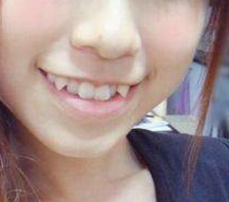 牙齿地包天导致骨头严重畸形,牙齿畸形缺失地包天怎么办