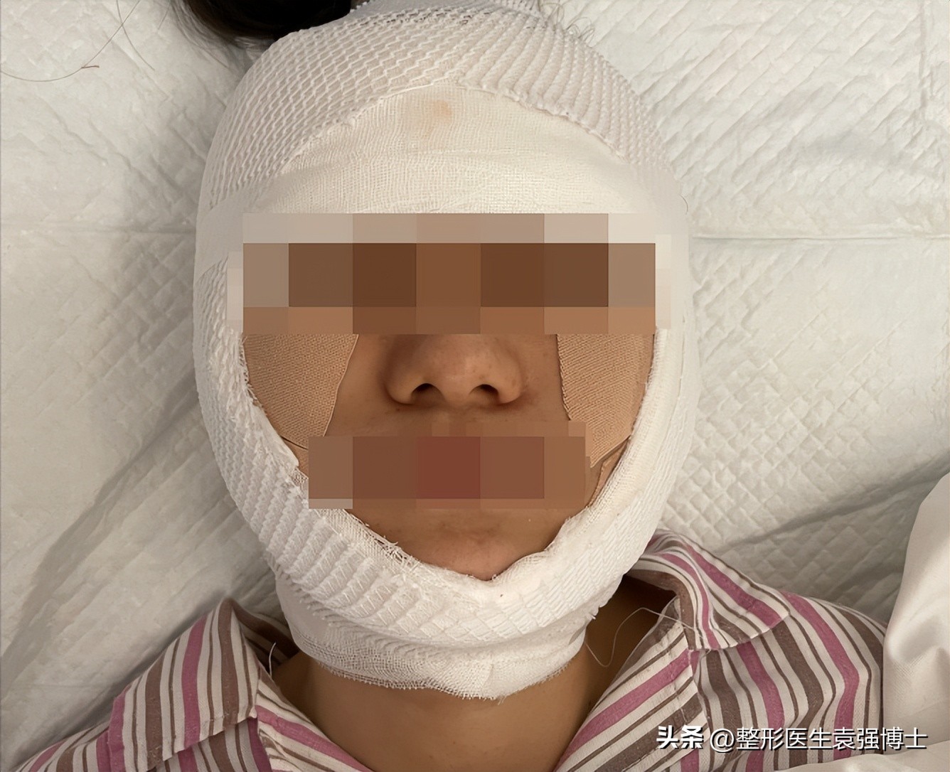 35岁做拉皮能挺几年,三十多岁做拉皮能维持多久