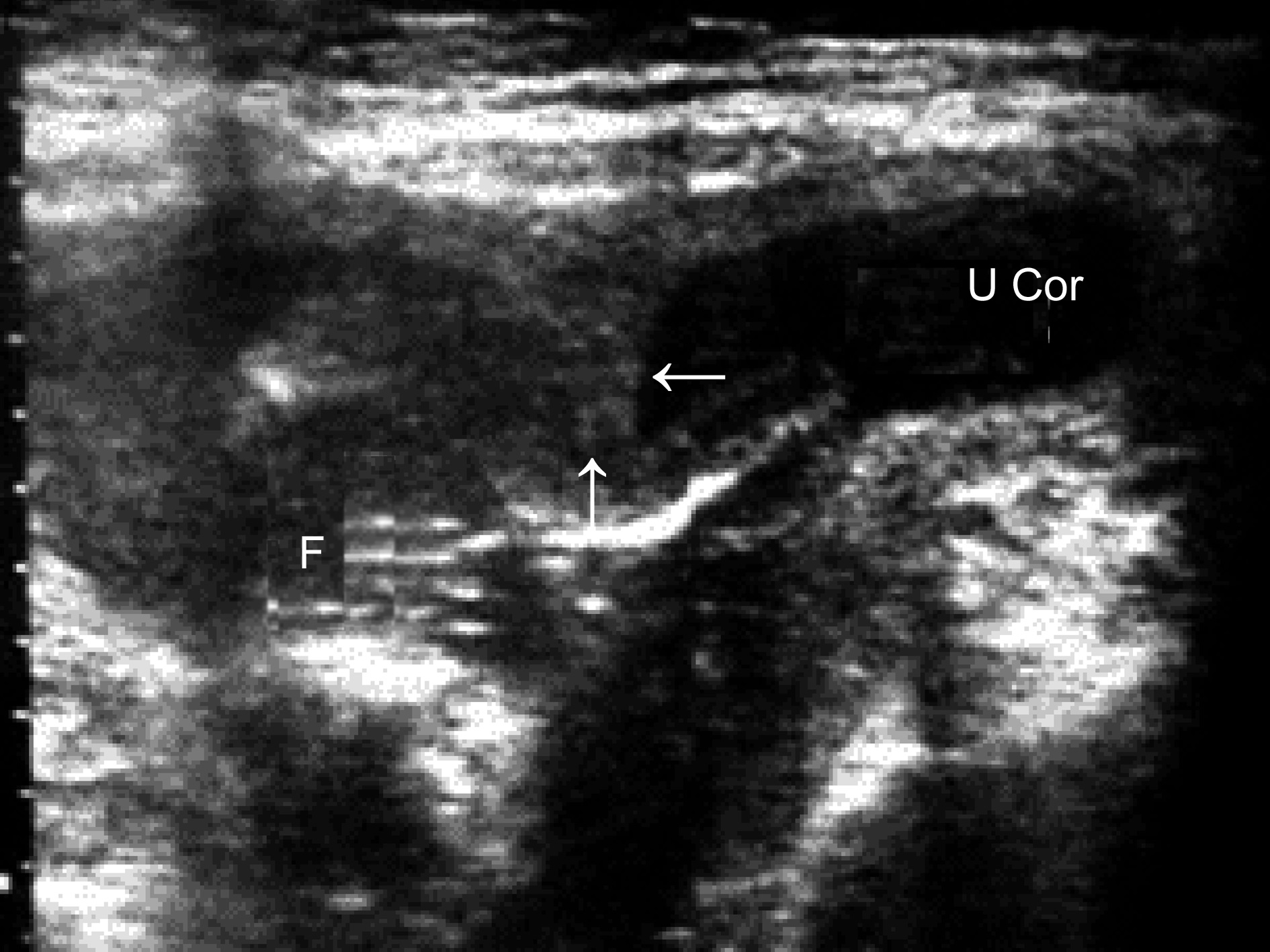 明明白白做超声33-14：双角子宫妊娠及残角子宫妊娠