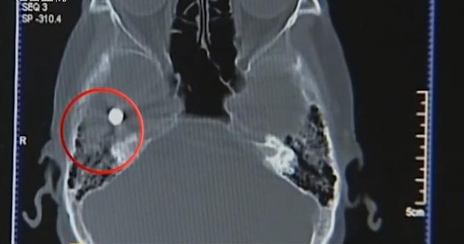 故事:江苏70岁老人头疼欲裂,检查时发现颅内有*弹子**,吓坏在场医生