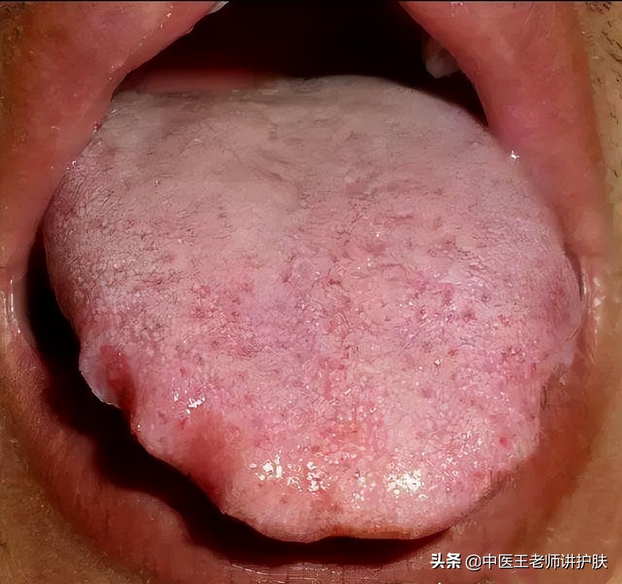 脾虚血瘀长斑怎么食疗,脾虚长痘吃中药多久能见效