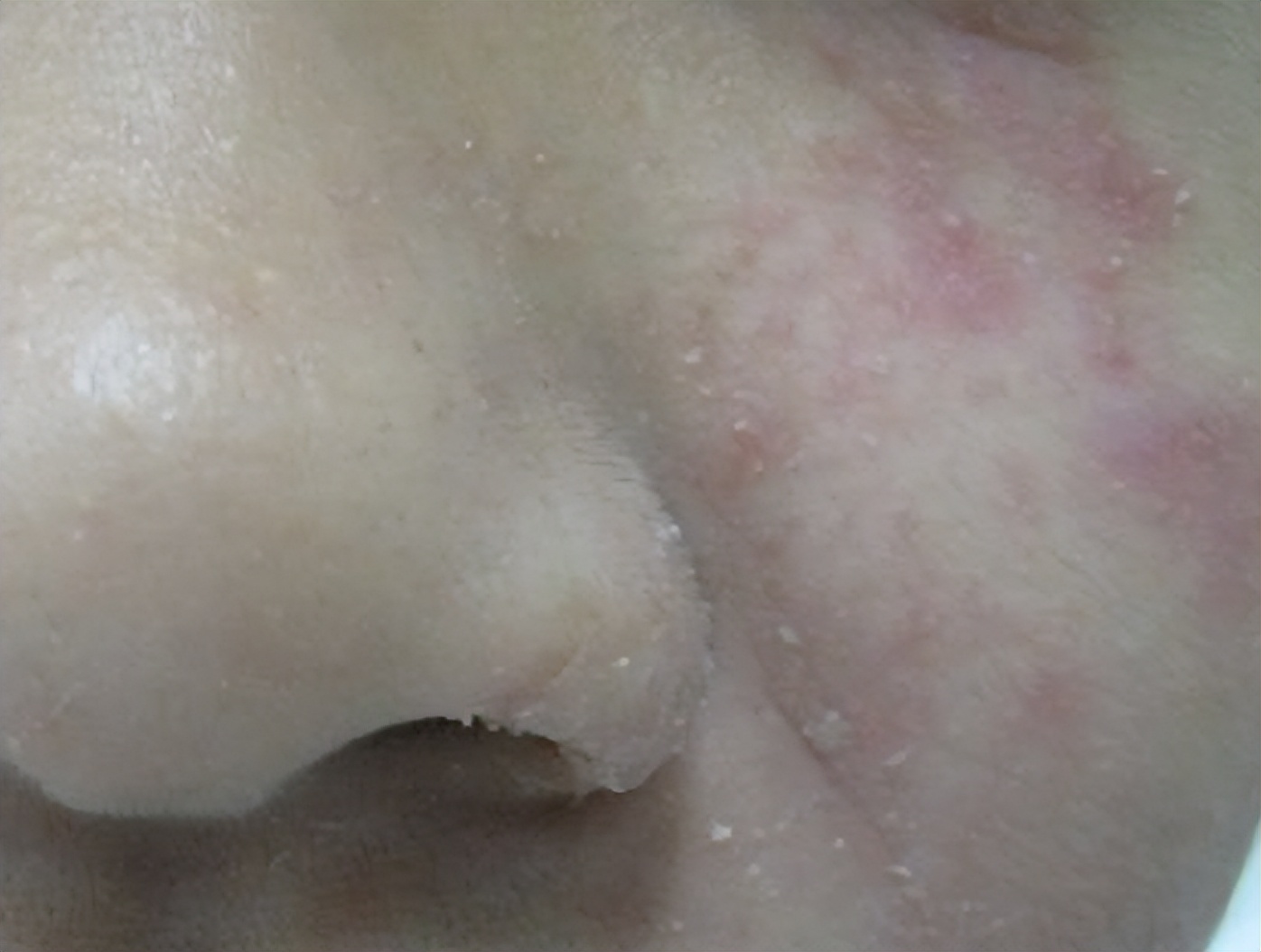 吃靶向药引起的皮疹怎么治疗最好,靶向药皮疹怎么处理