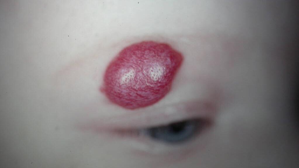 血管瘤要怎么治疗效果才最好,发现血管瘤怎么治疗好