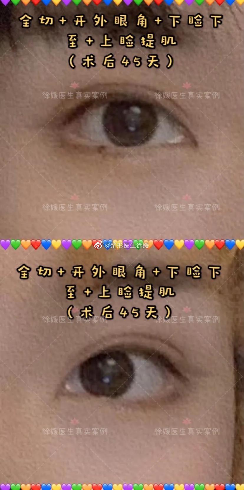 外眼角手术前后对比,做外眼角和不做外眼角的差别