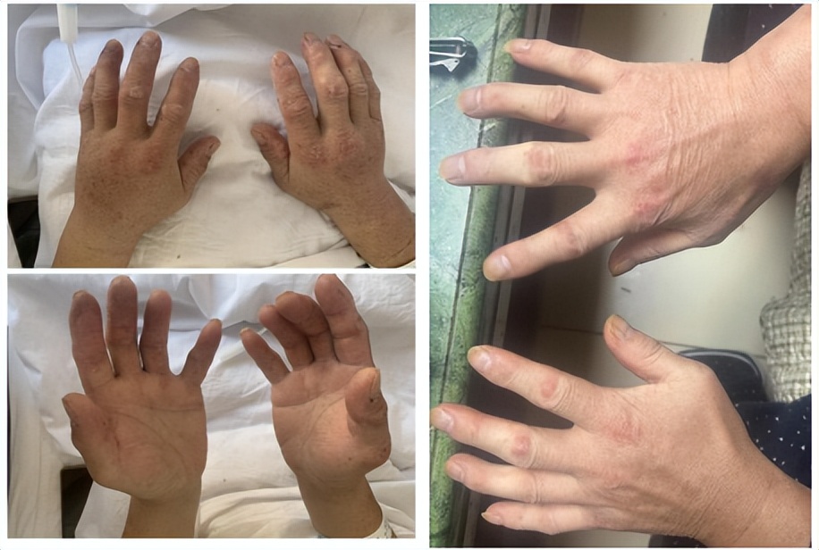 风湿免疫科专家解答,秦皇岛中医院风湿科