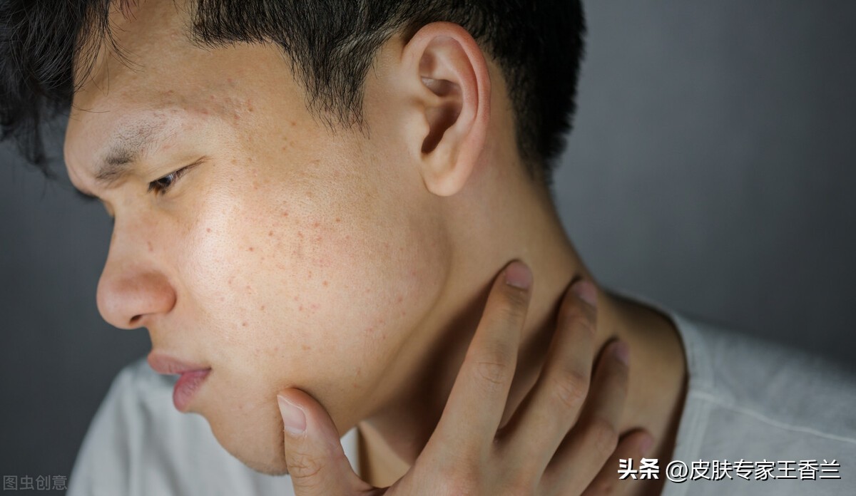 皮肤出油毛孔粗大起痘痘怎么回事,多油毛孔粗大皮肤粗糙容易长痘痘