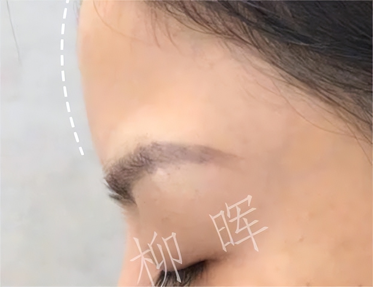 打玻尿酸变美的案例,额头玻尿酸1-7天恢复过程图