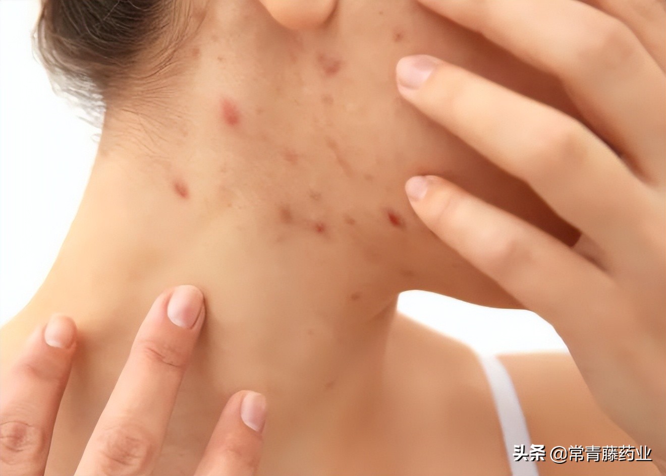 痘痘像蚊子包一样大怎么消,痘痘和蚊子包的黑印怎么消