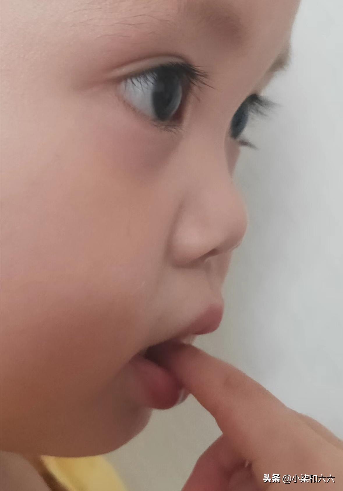 得了甲沟炎该怎么办？千万别急着拔甲