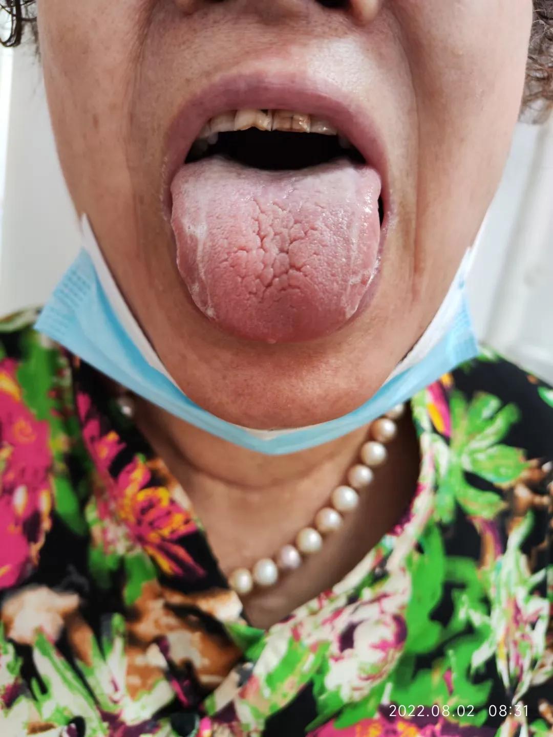 干燥综合征吃中药多久可以控制,干燥综合征喝中药可以治愈吗