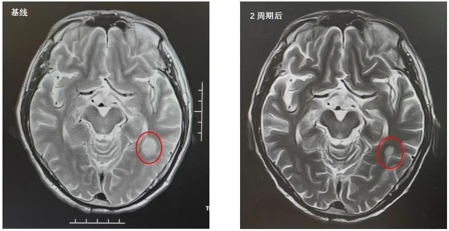 斯鲁利单抗治疗小细胞肺癌生存期,小细胞肺癌3a期用斯鲁利单抗
