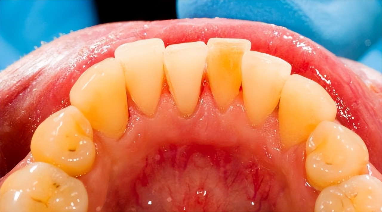 牙结石可以直接抠掉吗,牙结石能直接抠下来吗
