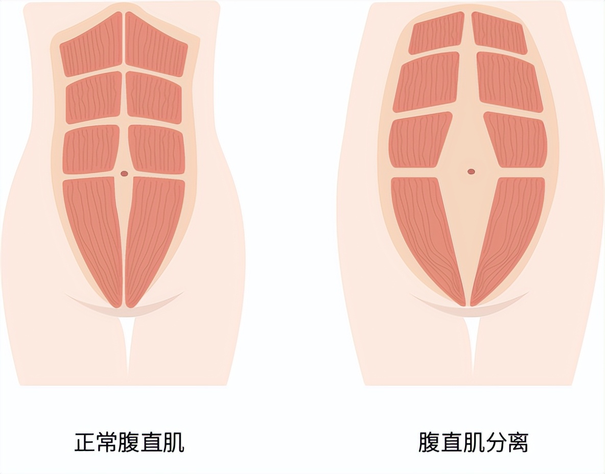 产后腰痛、腹部松垮？一文教你自测与修复腹直肌分离