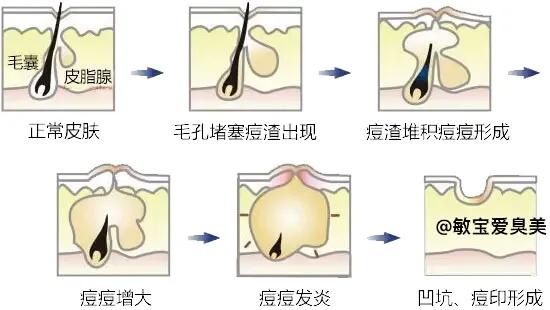 皮肤痘痘粉刺,各种皮肤痘痘问题讲解