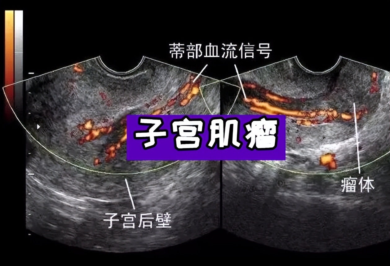 子宫肌瘤是怎么回事，怎么治才合理？老中医教你，一个泡脚方