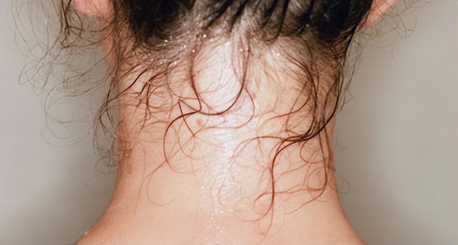 头颈部爱出汗,头颈部爱出汗头发全汗湿什么原因