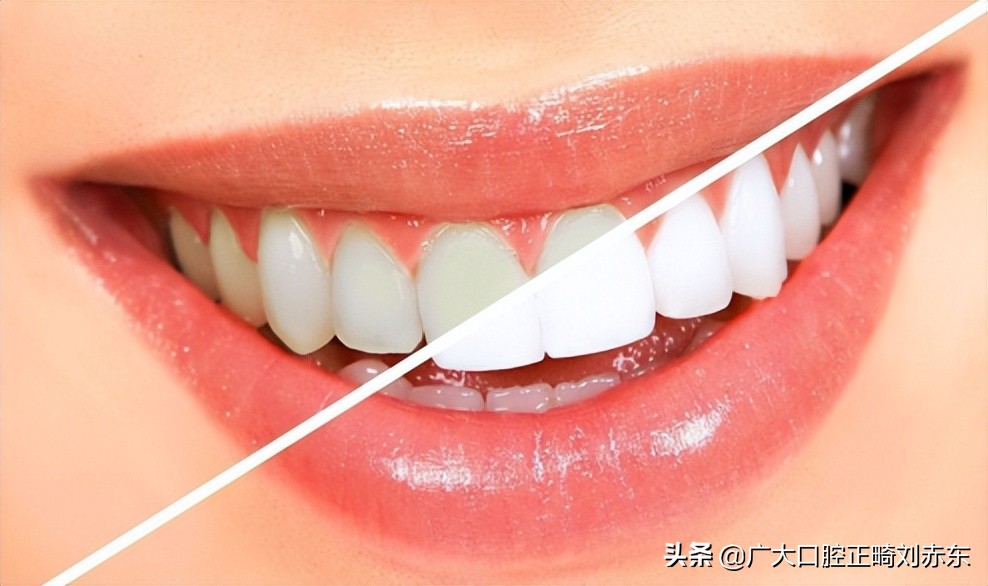 吃槟榔牙齿发黄怎么去除变白,牙齿抽烟发黄怎么去除变白