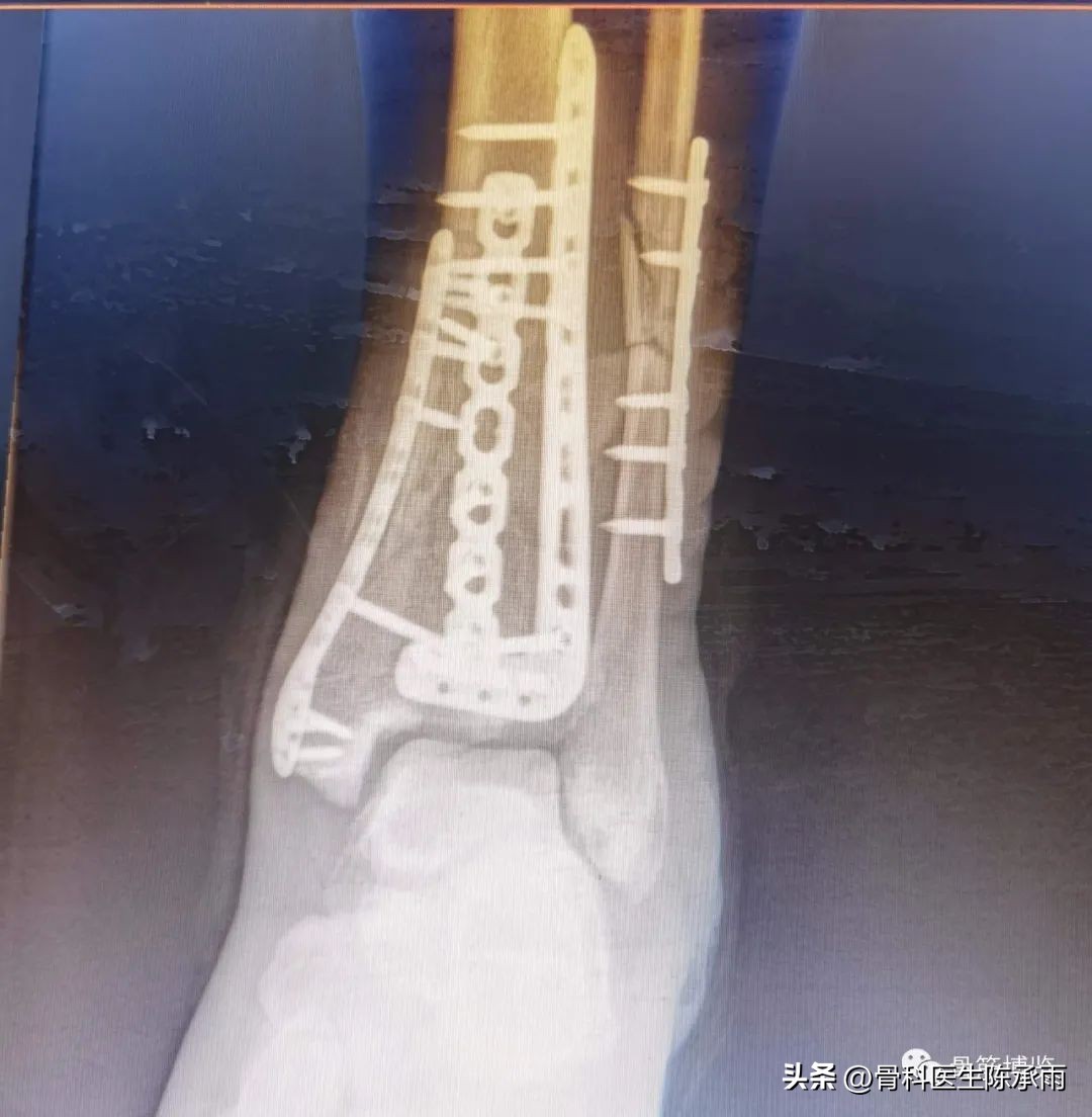 娓哥鐨摚淇,涔旀皬鐨摚淇瓒宠儗澶栦晶鐨偆缂烘崯