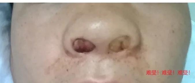 怎么治疗鼻出血,鼻出血介入治疗