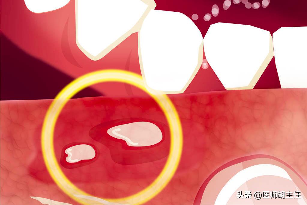 口腔溃疡吃维生素b1b2b12维生素c,治疗口腔溃疡的是维生素b2还是b12