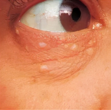 脂肪粒和闭口长什么样,脂肪粒闭口长啥样的