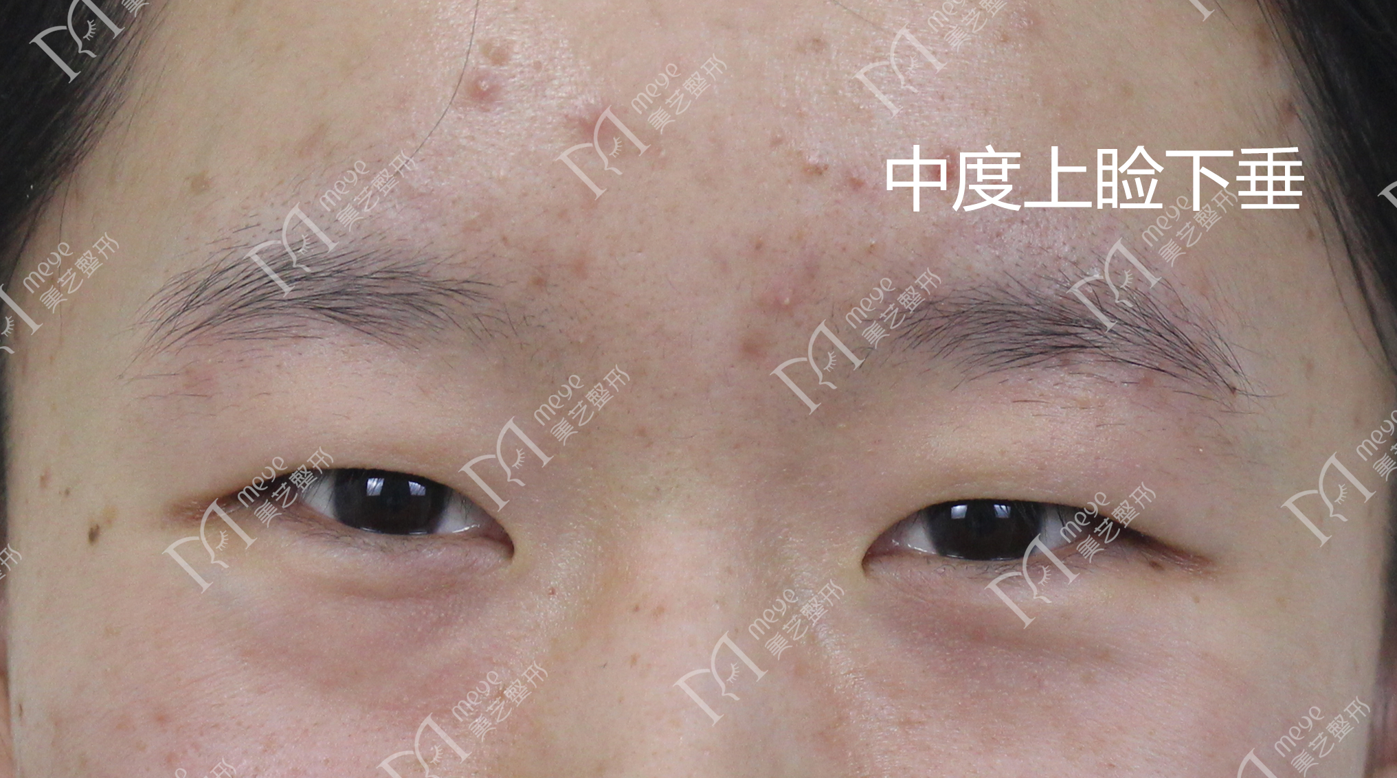 郑州修复双眼皮成功案例,郑州双眼皮修复全过程