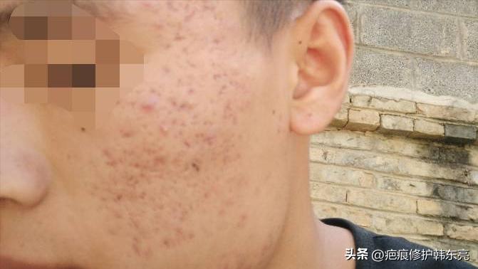 疤痕修复一次需要多少钱,上海九医院疤痕修复价目表2021